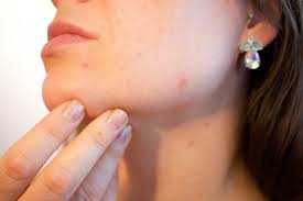 turmeric is great for acne