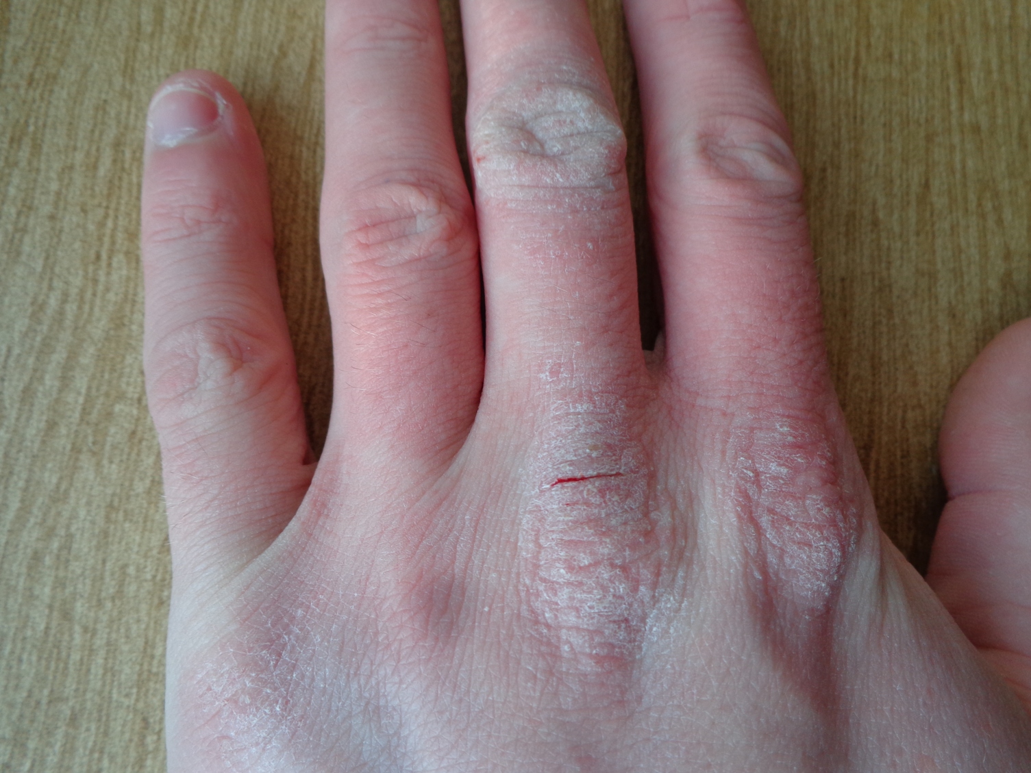 turmeric for dermatitis atopica