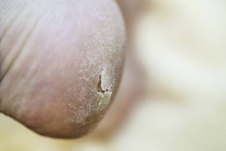 turmeric for cracked heels