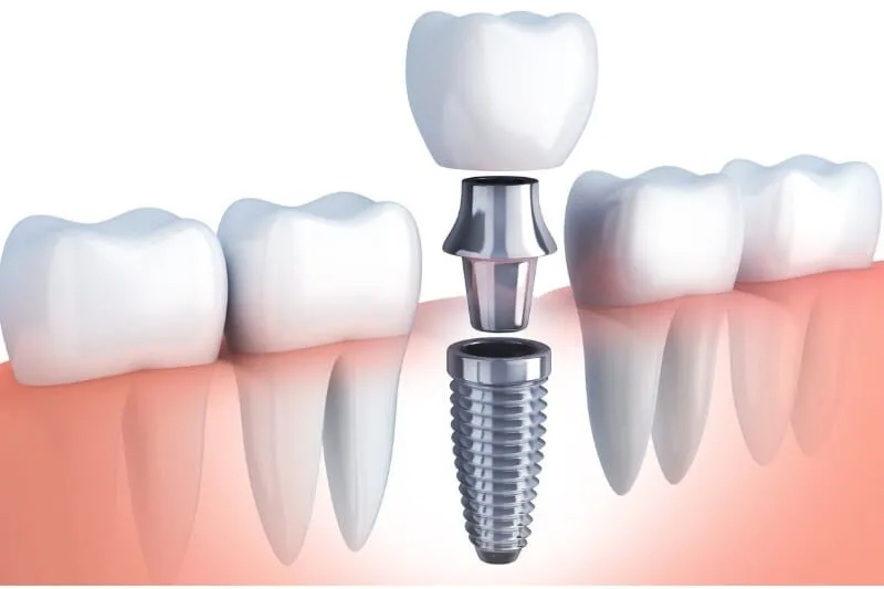 dental-implants5WAcqzi