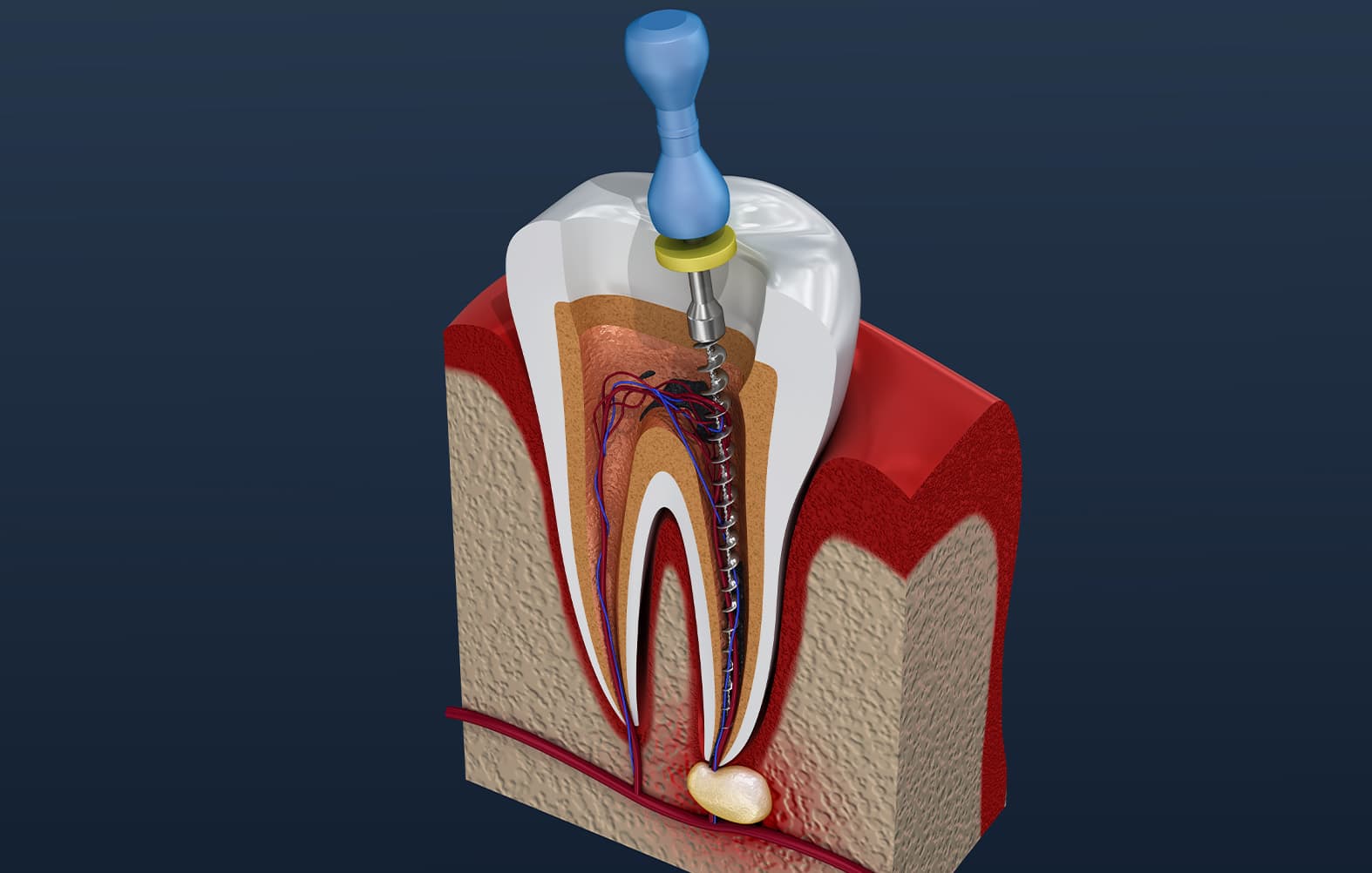 Root-Canal-Treatment