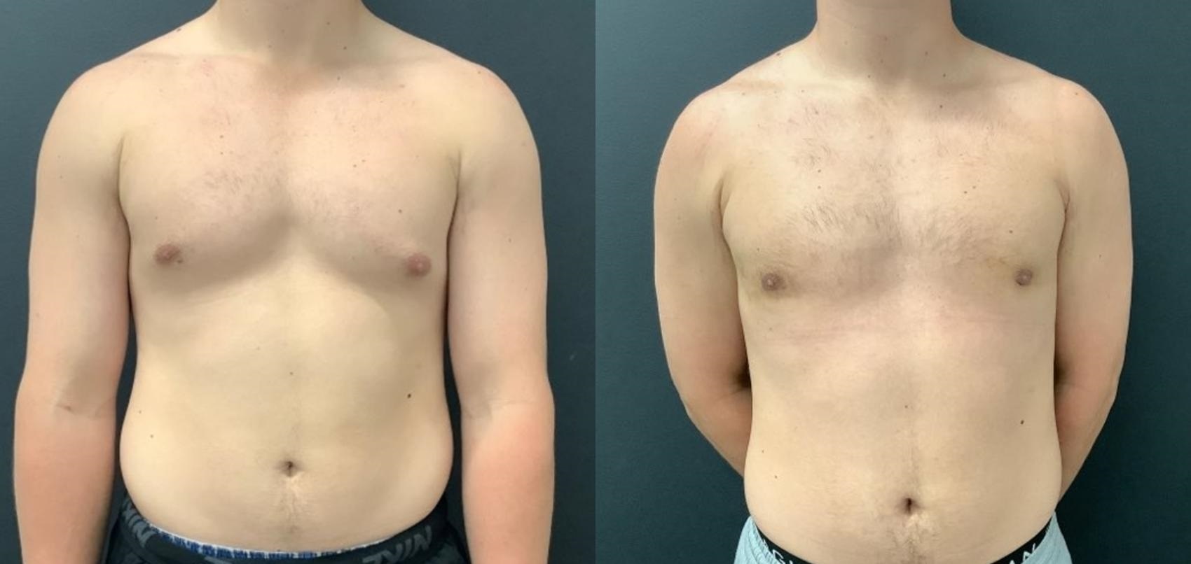 gynecomastia-surgery-in-dubai
