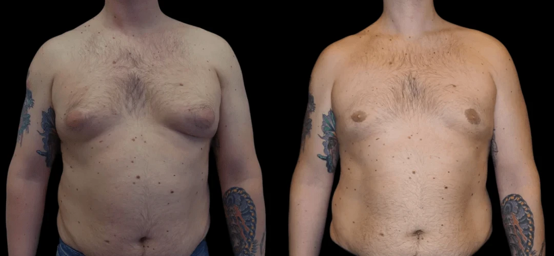 male-breast-reduction